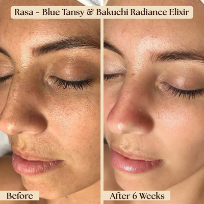Before and after comparison of a woman's face with Rasa Blue Tansy & Bakuchi Radiance Elixir.
