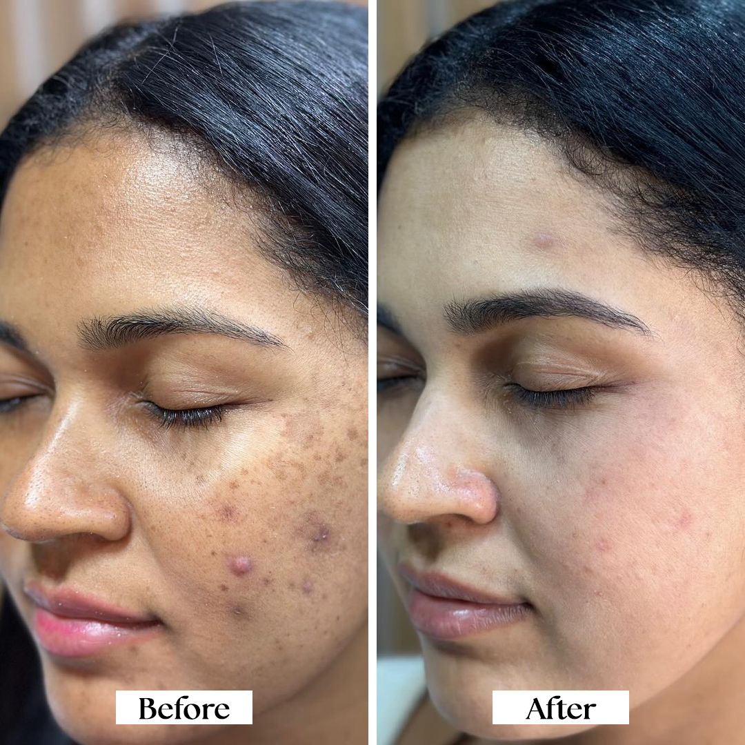 Before and after comparison of a woman's face with acne on the left and clear skin on the right.