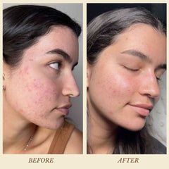 Before and after comparison of a woman's face with acne on the left and clear skin on the right.
